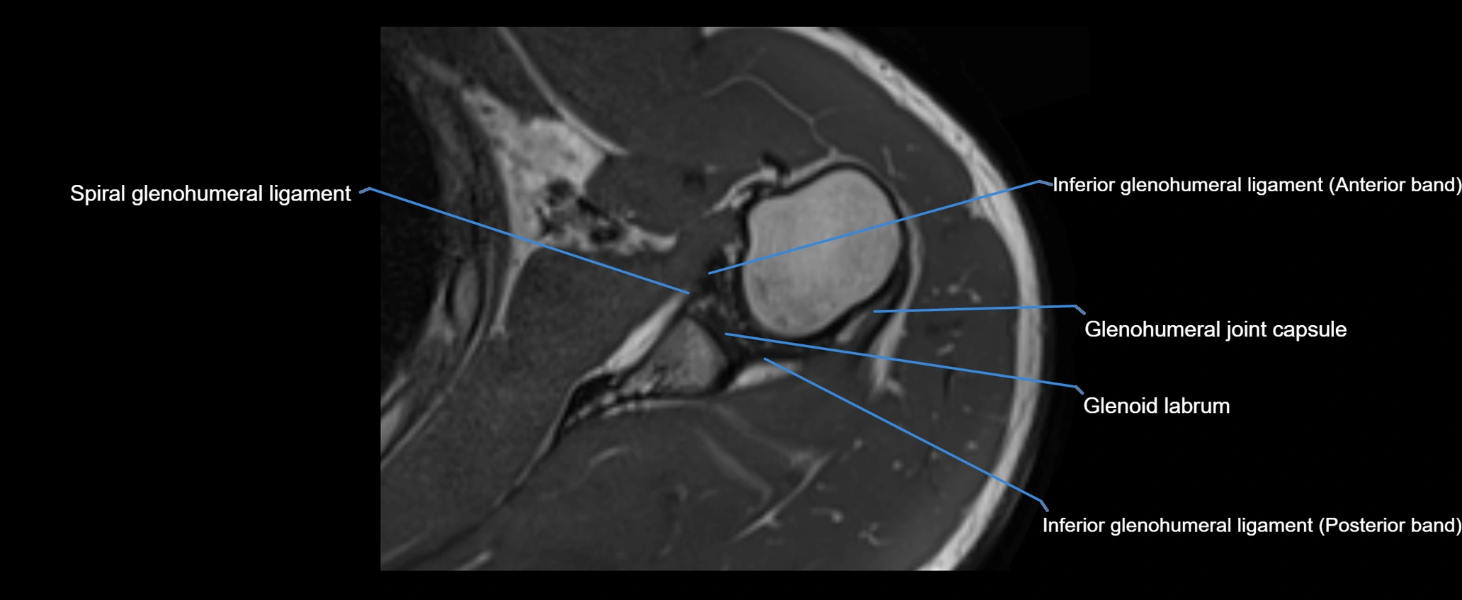 shoulder ligaments axial 3d 3t mri image-img-00005-00082.webp